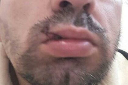 Jovem quebra dois dentes ao apanhar do ex da namorada no Jardim Anache